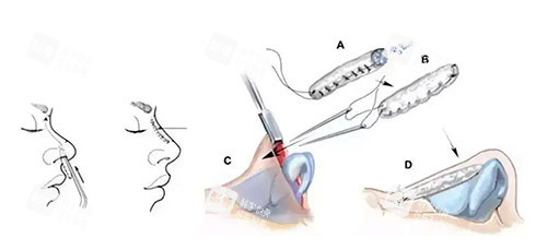 隆鼻手术方法图 隆鼻手术方法图