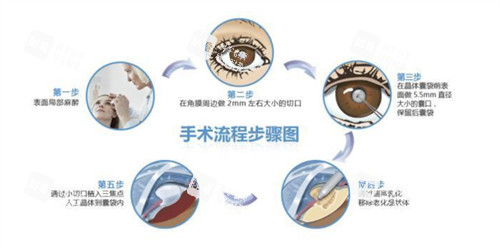 白内障三焦点人工晶体手术过程