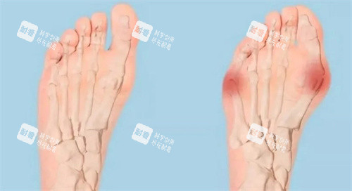 拇外翻对比 拇外翻对比