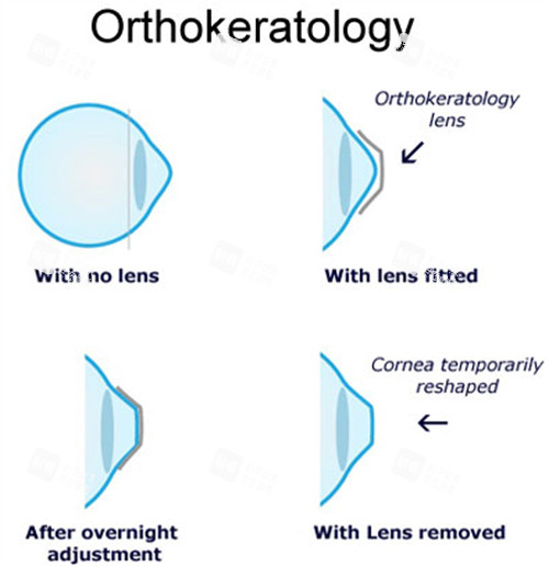 角膜塑形镜佩戴前后对比