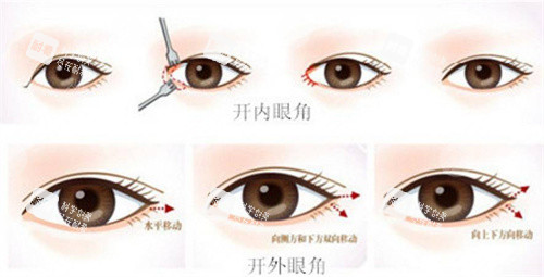 开内眼角、外眼角 开内眼角、外眼角