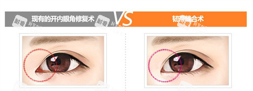 内眼角回包修复会毁眼睛吗？成功概率高不高？正规解答修复后眼睛变小的疑虑！