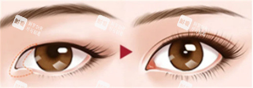 开内眼角术图 开内眼角术图