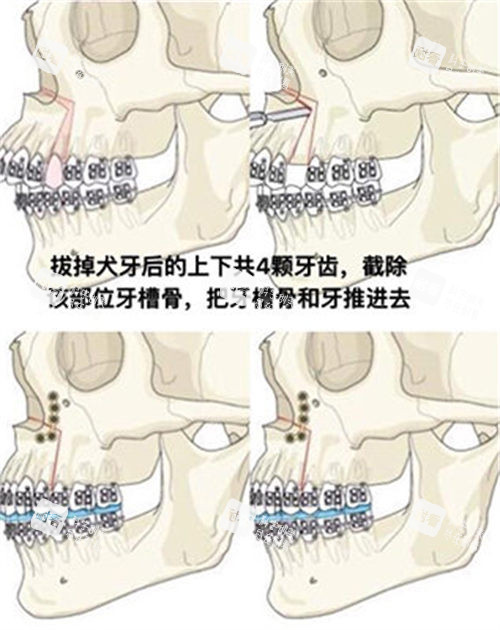双鄂手术方式演示动画图