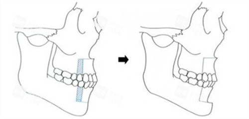 双鄂手术过程演示动画图