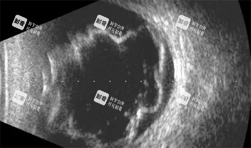 孔源性视网膜脱离扫描细节 孔源性视网膜脱离扫描细节