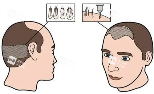 发际线植发 发际线植发