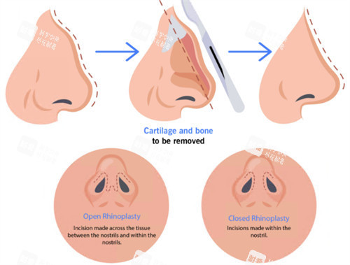 驼峰鼻矫正图示 驼峰鼻矫正图示