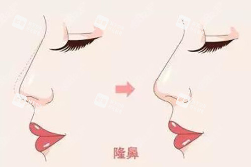 隆鼻对比示意图 隆鼻对比示意图
