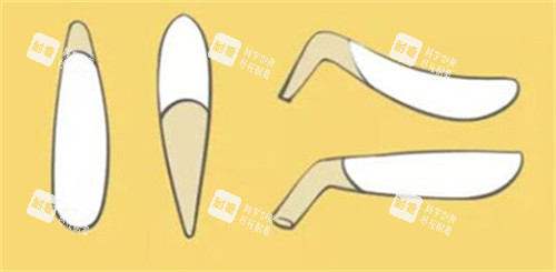 假体隆鼻展示照片 假体隆鼻展示照片