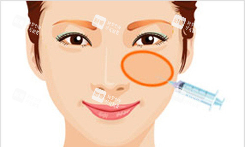 面部苹果肌填充图 面部苹果肌填充图