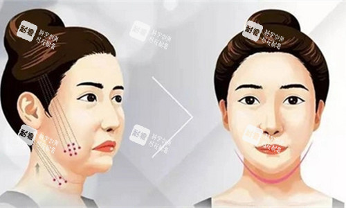 埋线提升卡通图 埋线提升卡通图