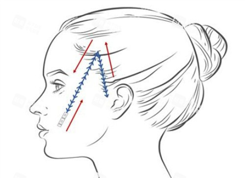 面部埋线卡通示意图