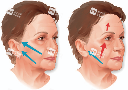 面部提升年轻化图片