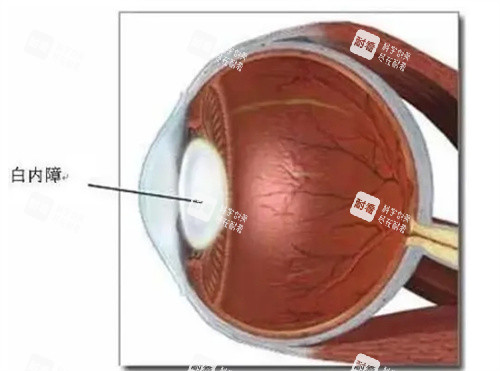陕西白内障手术哪家医院好？含超声乳化/飞秒白内障技术优势+医生推荐
