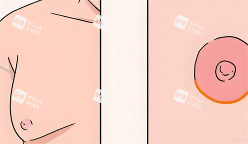 乳房缩小后术对比 乳房缩小后术对比