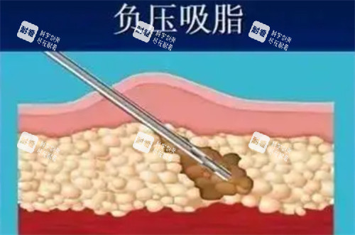 负压吸脂 负压吸脂
