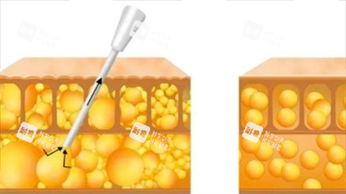 吸脂过程动画脂肪前后变化