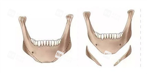 下颌角成角截骨术 下颌角成角截骨术