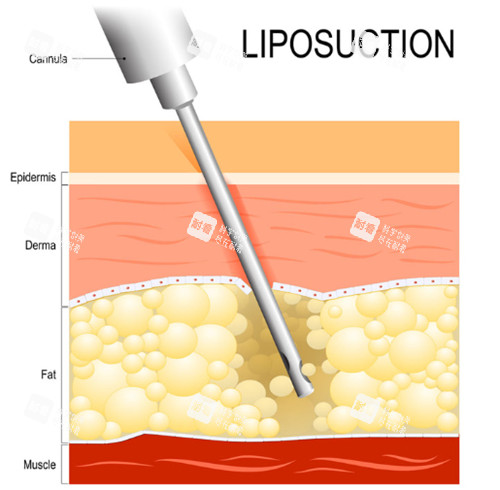 抽脂手术动画演示 抽脂手术动画演示