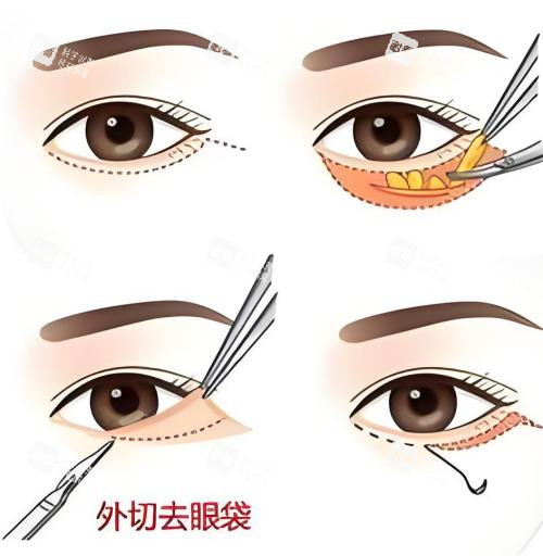 外切去眼袋演示动画图 外切去眼袋演示动画图
