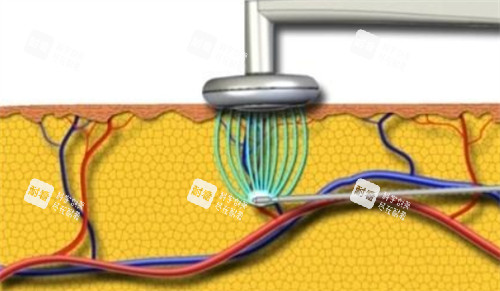 吸脂仪器 吸脂仪器
