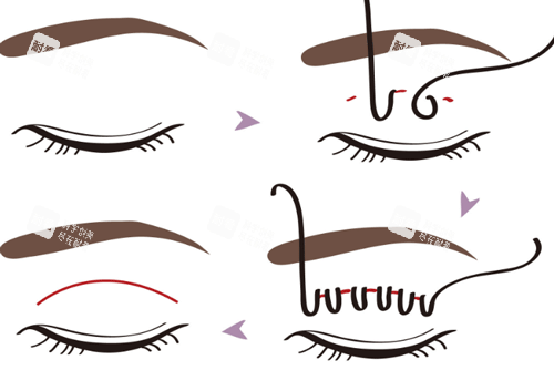 埋线双眼皮手术步骤图 埋线双眼皮手术步骤图