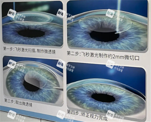 飞秒手术过程图 飞秒手术过程图