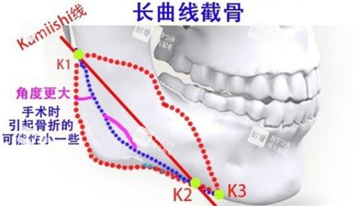 下颌角长曲线截骨的截骨位置