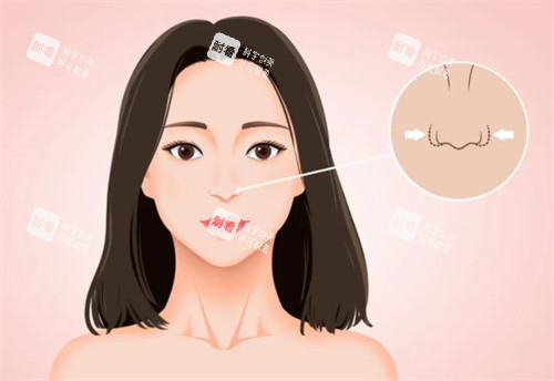 鼻翼缩小卡通图