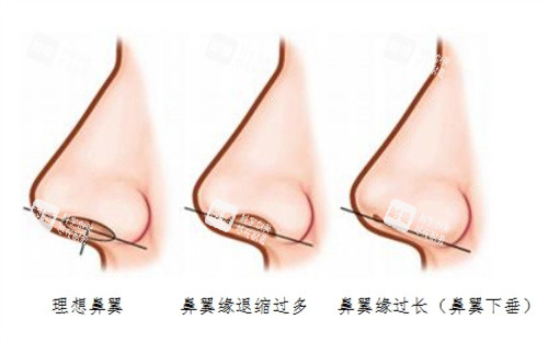 鼻翼退缩矫正术图片实例