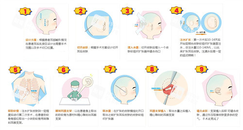 扩张器法耳再造手术动画演示图