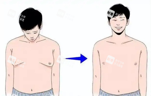 男性乳房发育吸脂前后示意图