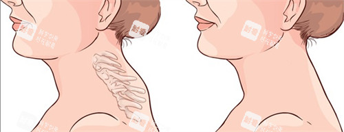 广州李方伟医生做富贵包口碑怎么样？不仅小创口吸脂干净且不留疤，术后脖子挺拔评价确实高