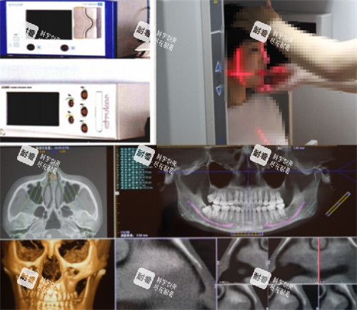 杭州连天美整形高俊明磨骨术前检查 杭州连天美整形高俊明磨骨术前检查