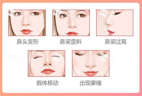 鼻整形图示