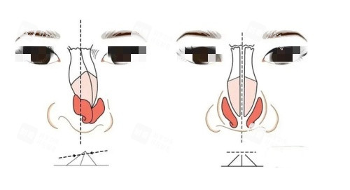 假体鼻子歪斜漫画示意图 假体鼻子歪斜漫画示意图