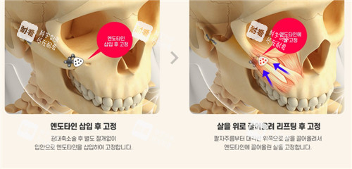 颧骨部位解析图 颧骨部位解析图