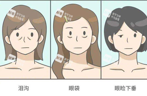 眼周衰老问题卡通示意图 眼周衰老问题卡通示意图