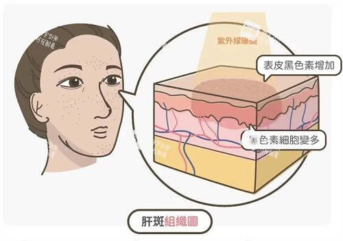 祛斑卡通图 祛斑卡通图