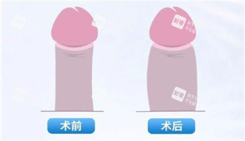 男性私密脂肪填充