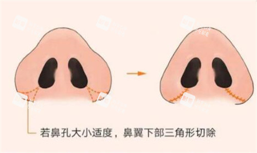 鼻翼缩小改善照片 鼻翼缩小改善照片