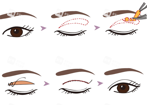 双眼皮手术展示