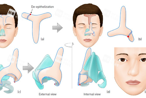 武汉鼻再造手术收费价格表：传统术式单价5万元起、显微外科价格8万元起、复合组织移植技术10万元起
