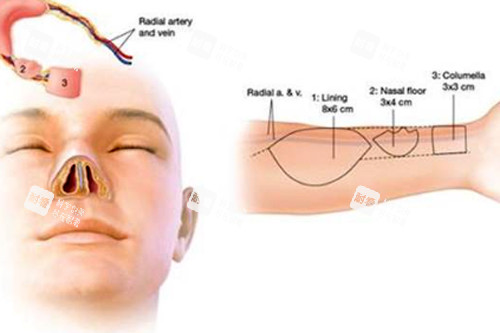 鼻再造可取皮部位 鼻再造可取皮部位