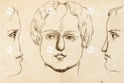 鼻再造术后 鼻再造术后