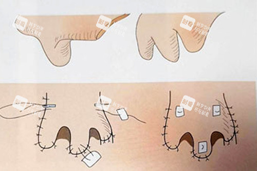 鼻再造术后变化 鼻再造术后变化