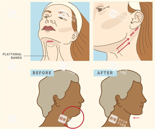 面部提升改善下颌