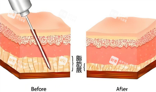 吸脂手术脂肪层对比