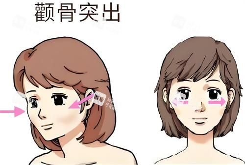颧骨突出动画演示图